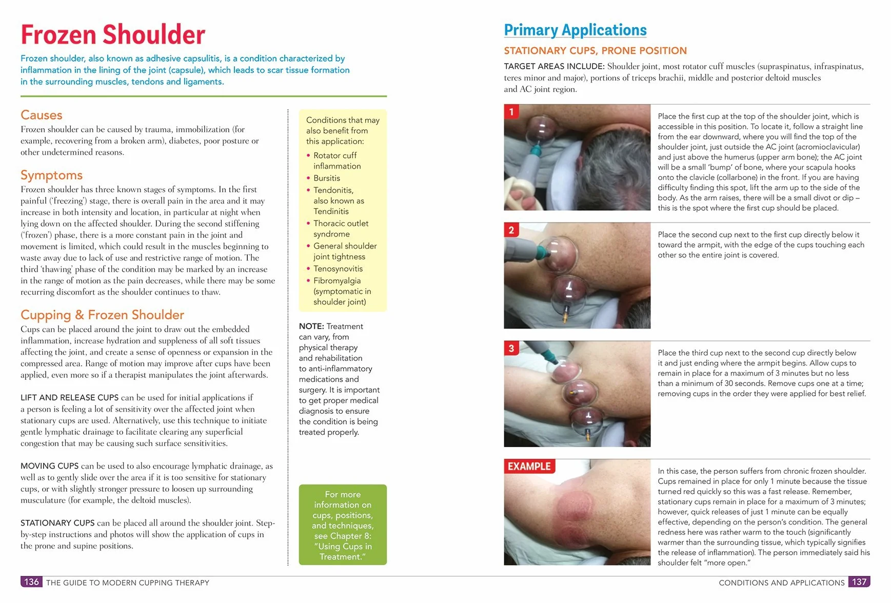 The Guide to Modern Cupping Therapy: Your Step-By-Step Source for Vacuum Therapy