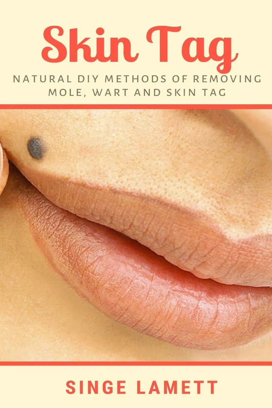 Skin Tag: Natural DIY Methods of removing Mole, Wart and Skin Tag